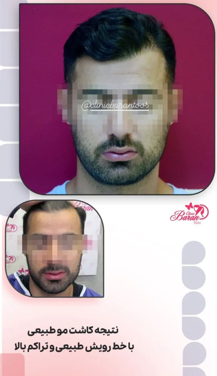 قبل و بعد کاشت مو با خط رویش طبیعی و استاندارد 3